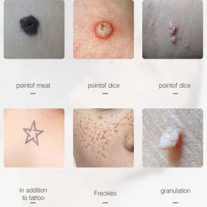 بیوتی پن 9 قدرته چراغ دار MOLE REMOVAL PEN